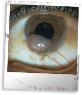 Corneal Ulceration